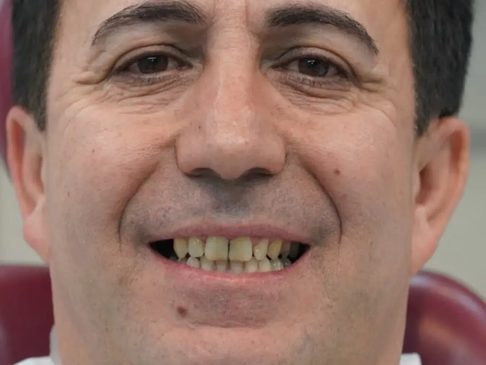 Tedavi öncesi diş implantı — kliniğimizde tamamlanan çalışma