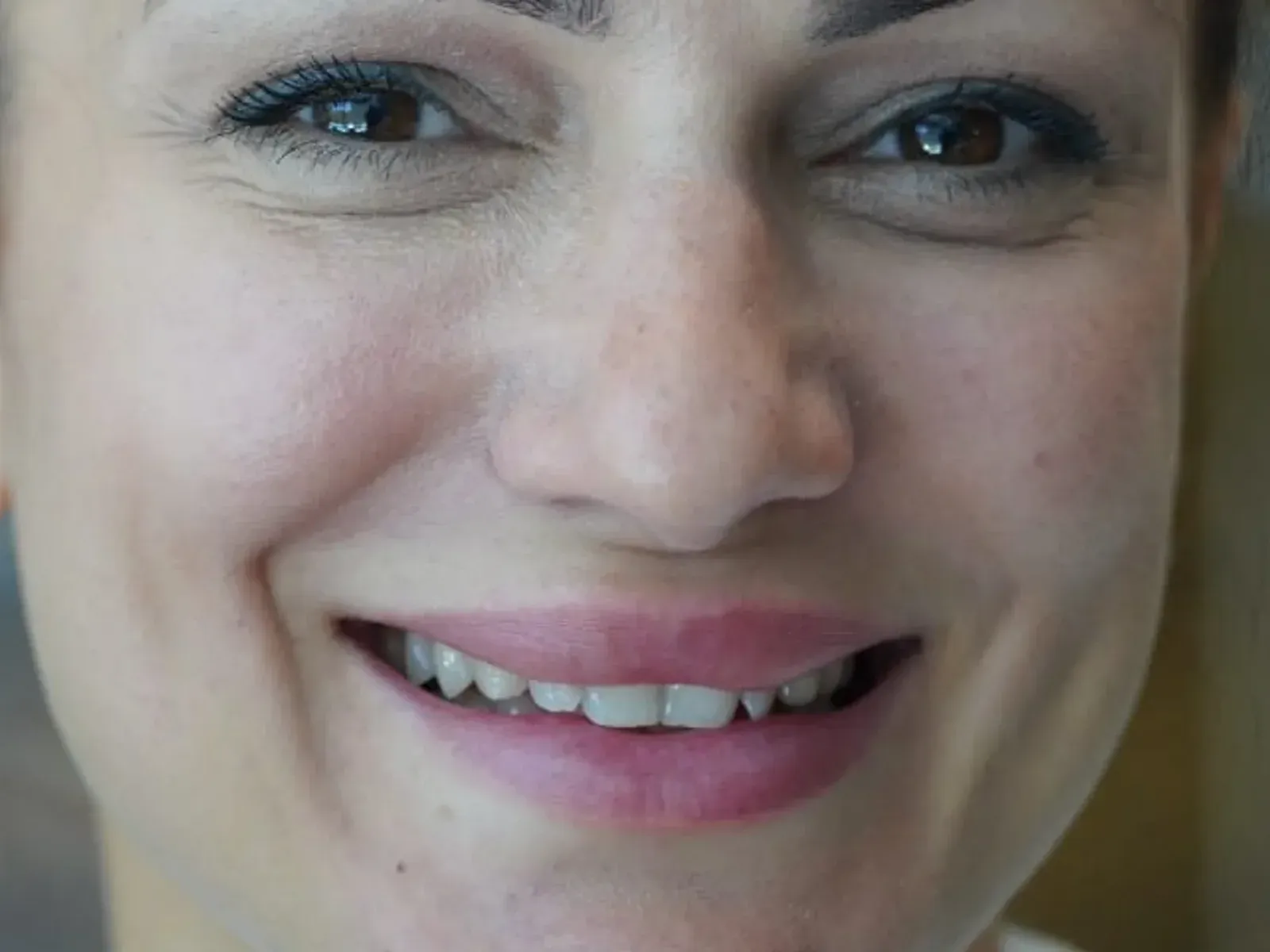 Tedavi öncesi diş implantı — kliniğimizde tamamlanan çalışma